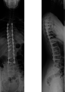 patient's spine after alif and plif correction
