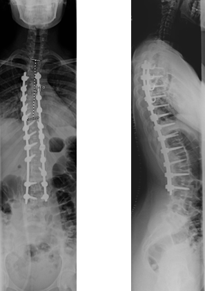 patient's spine after alif and plif correction
