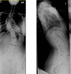 x-ray of spine with adolescent idiopathic scoliosis