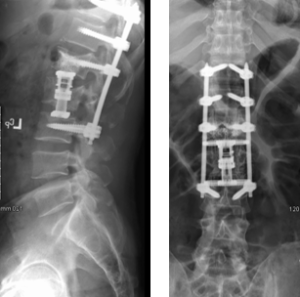 Case Study: Repair of L1 & L2 Burst Fractures | Surgery