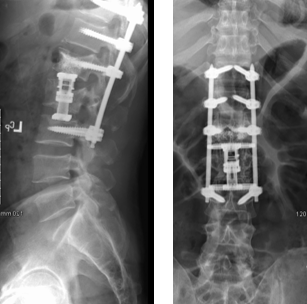 patient's lumbar spine after receiving XLIF Corpectomy & Kyphoplasty for burst fractures