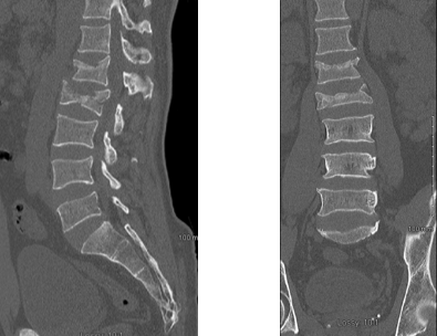 x-ray of patient's lumbar spine with burst fracture at L2 and compression fracture at L1