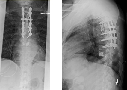 postoperative imaging of patient's spine after surgical treatment for spinal tumors