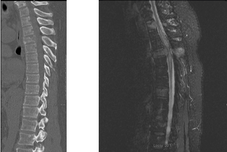 preoperative imaging of spinal tumors in thoracic spine