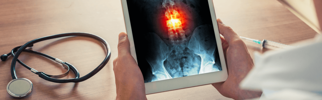 image of doctor holding x-ray with burst fracture