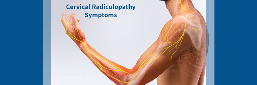 cervical radiculopathy symptoms