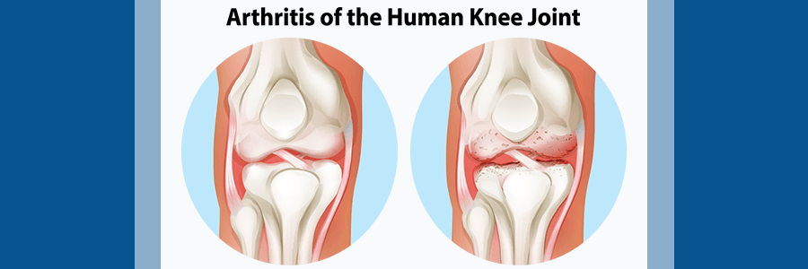 knee with arthritis