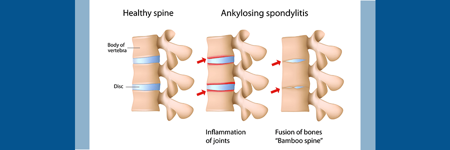 healthy spine vs. spine with ankylosing spondylitis