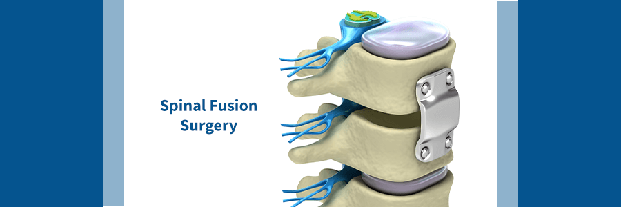 spine with fixation from spinal fusion surgery
